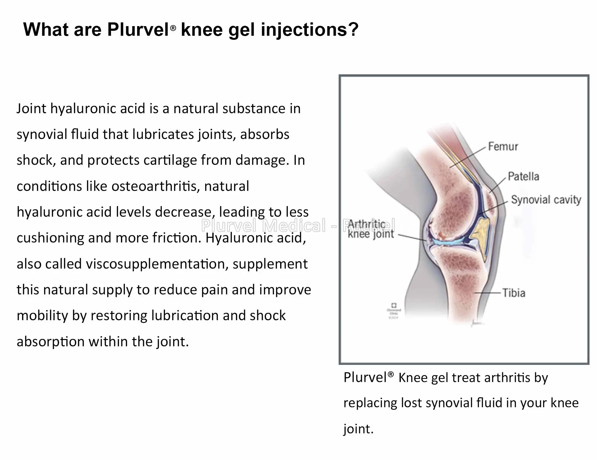 Non-Crosslinked Intra-Articular Knee Gel Hyaluronic Acid 2cc — Orthopedic HA product image 3